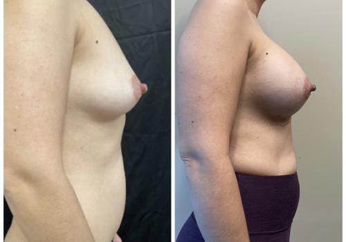 Real patient breast augmentation before and after photos